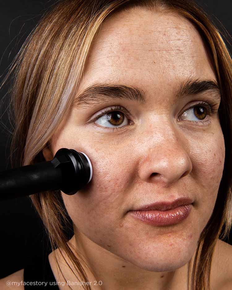 Scarring and Acne Kit - Image 6